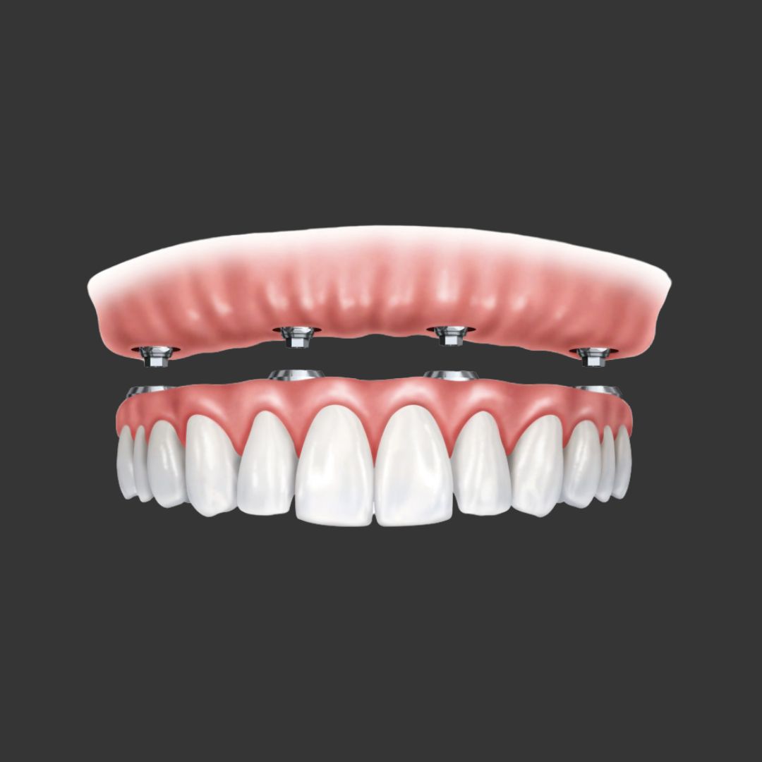 All on 4/6固定式重建